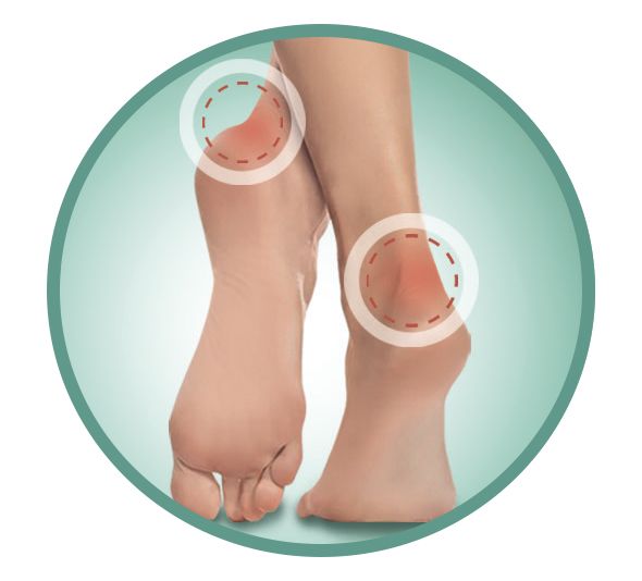 Протектор на задник обуви S19-12 Sursil-Ortho, пара купить в OrtoMir24